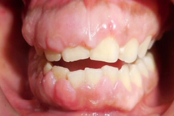 Before gingival